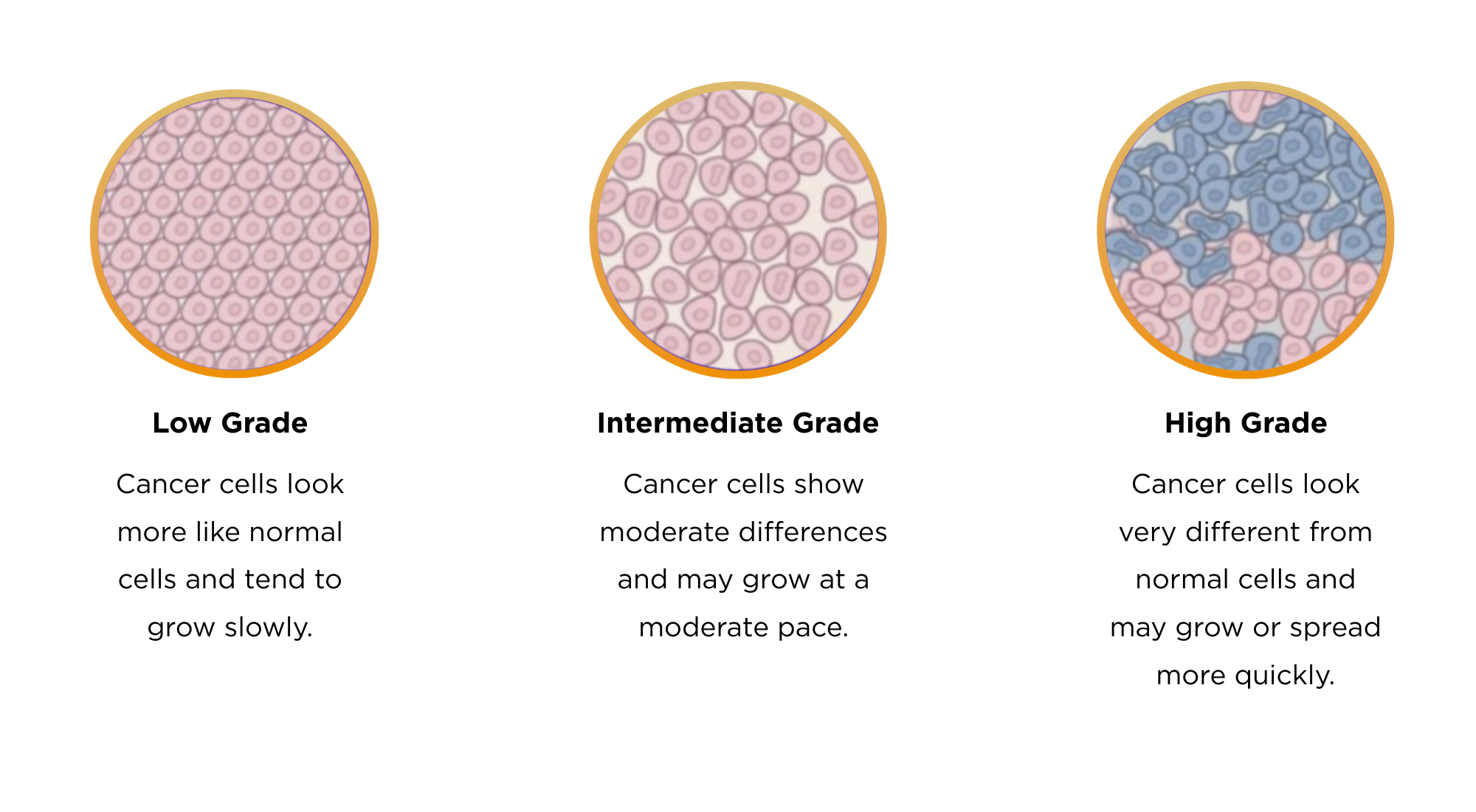 Grading of Cancer
